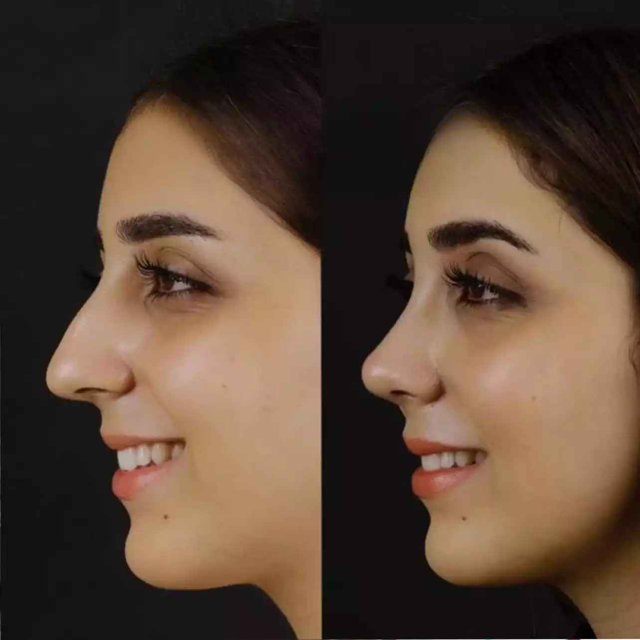 Rhinoplasty in Dubai