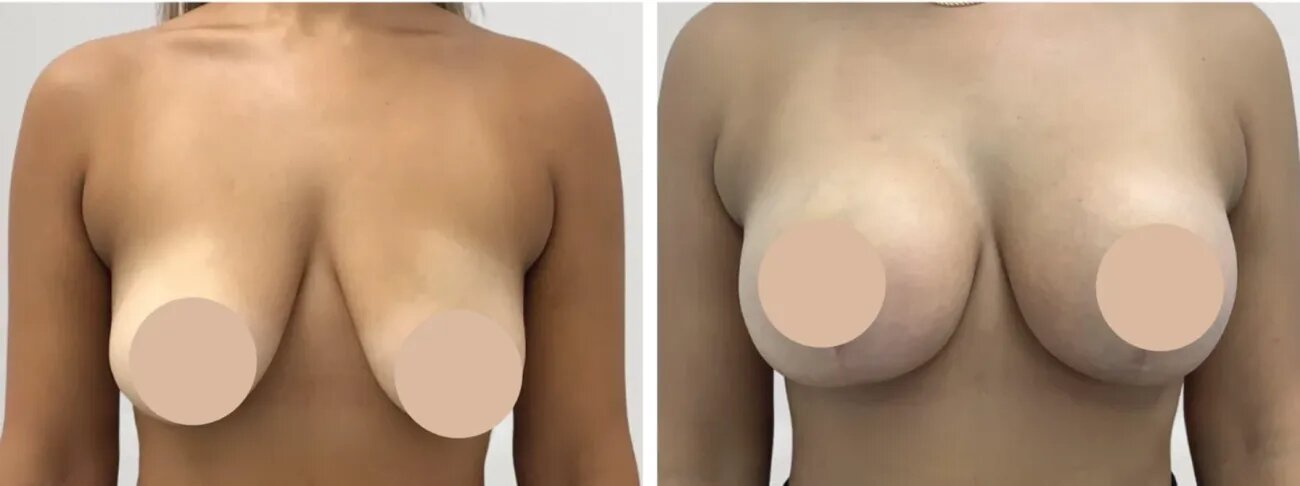 Best Doctors in Dubai for Breast Reduction Surgery: Complete Guide