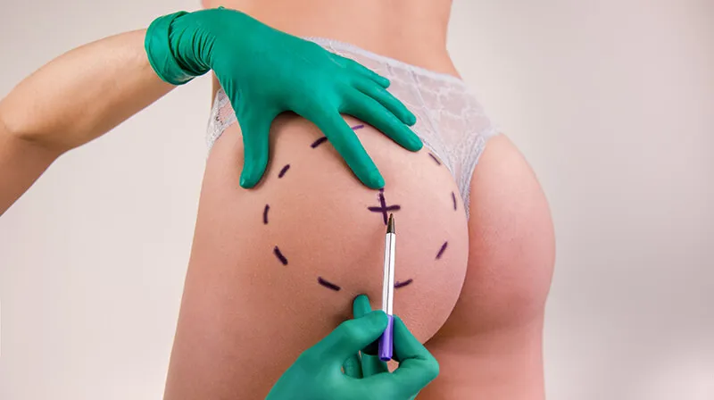 Butt Fillers in Dubai for Enhanced Shape and Projection
