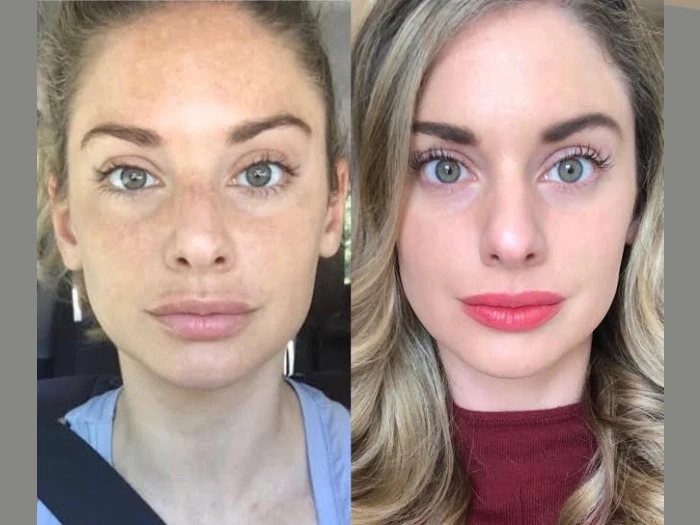 Clinical Radiofrequency (RF) Microneedling Treatment in Dubai