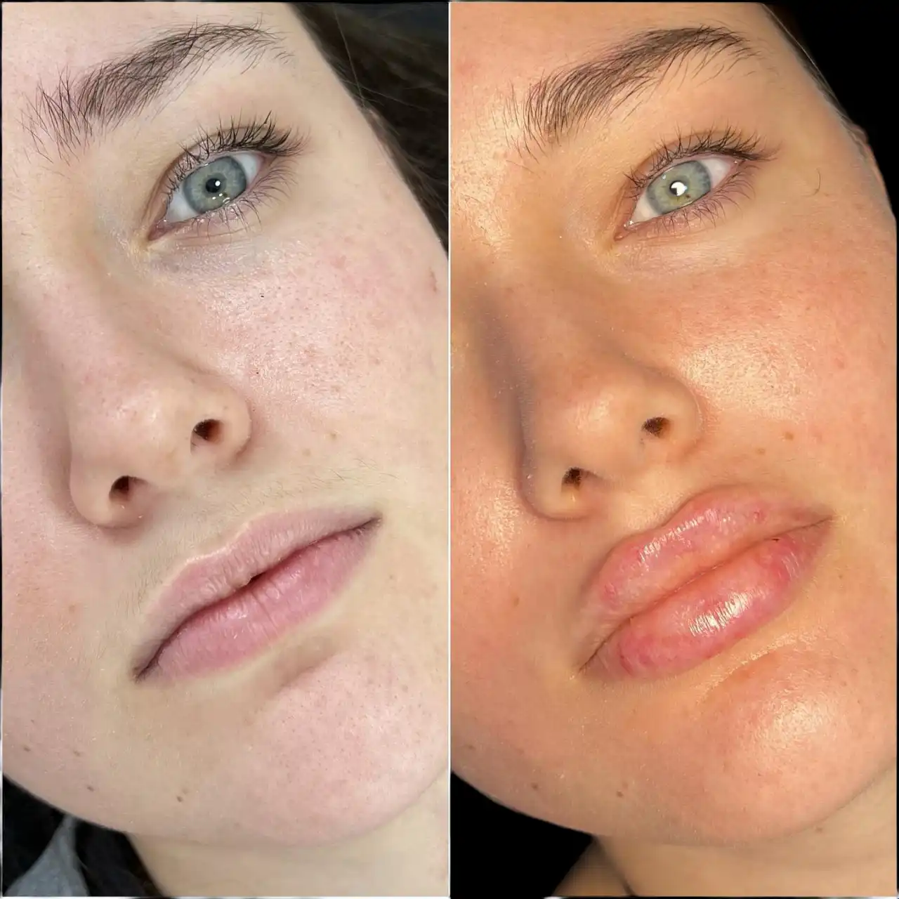 Best Doctors in Dubai for Fillers for Age-Defying Transformations