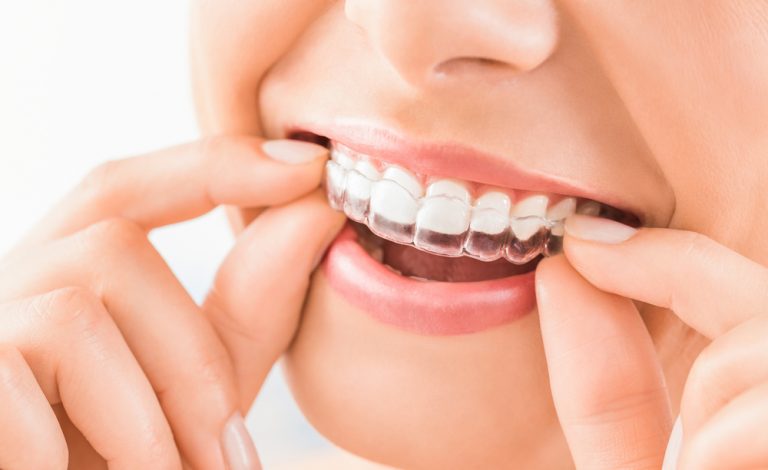 Invisalign Braces Dubai: Straighten Your Teeth Discreetly and Comfortably
